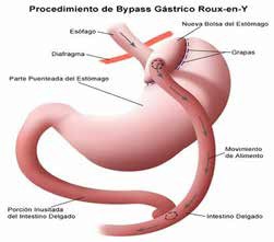 bypass_gastrico